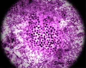 West Nile, un morto al Sant’Anna