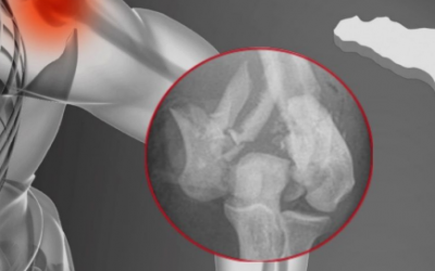 Chirurgia del Gomito: Ferrara al centro della formazione scientifica con il Congresso Regionale SICSeG